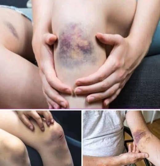 This image has an empty alt attribute; its file name is %E2%9A%A0%EF%B8%8F-BE-CAREFUL-if-you-get-these-bruises-on-your-body-it-means-you-have-Ca.see-more-4.jpg
