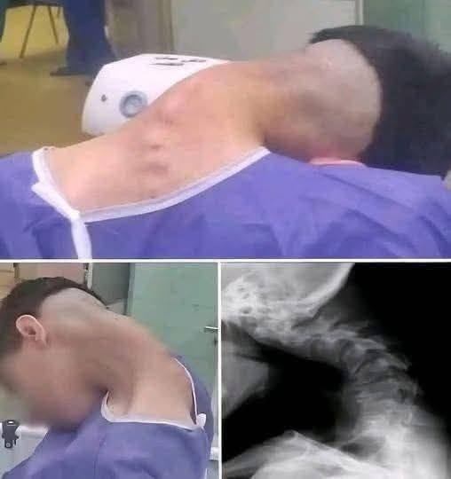 This image has an empty alt attribute; its file name is Young-man-hospitalized-because-he-dropped-his-ca.See-more-in-comment-1.jpg